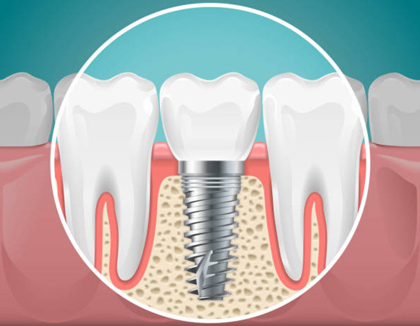 Implantologia Dentale - Impianti