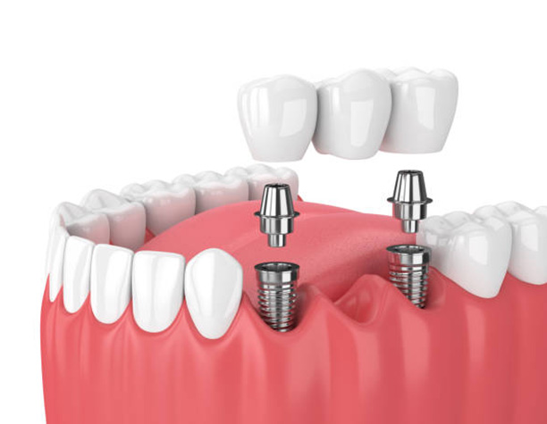 Implantologia Dentale - Impianti